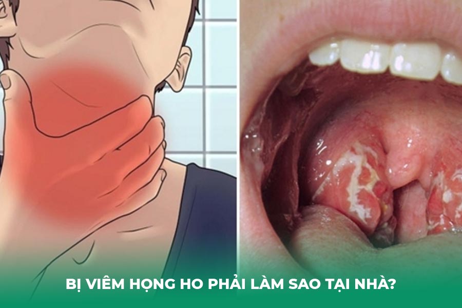 bị viêm họng ho phải làm sao