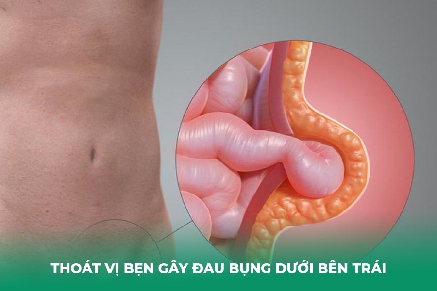 Thoát vị bẹn gây đau bụng dưới bên trái