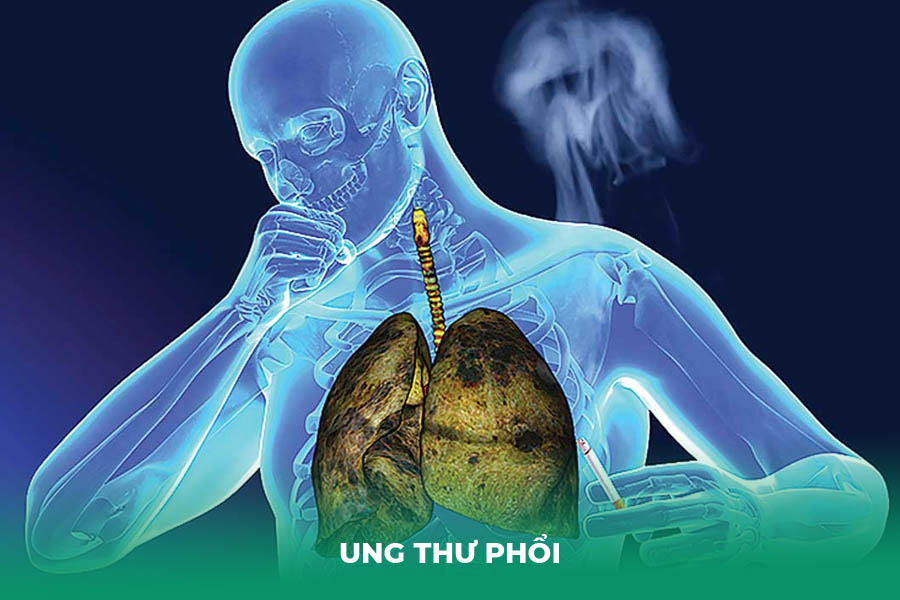 Ung thư phổi