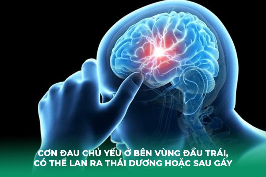 Cơn đau chủ yếu ở bên vùng đầu trái, có thể lan ra thái dương hoặc sau gáy