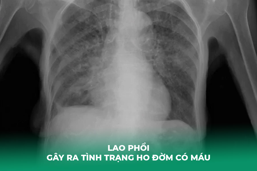 Lao Phổi Gây Ra Tình Trạng Ho Đờm Có Máu