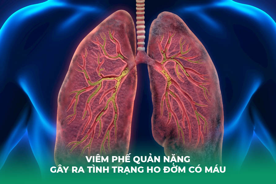 viêm phế quản nặng Gây Ra Tình Trạng Ho Đờm Có Máu