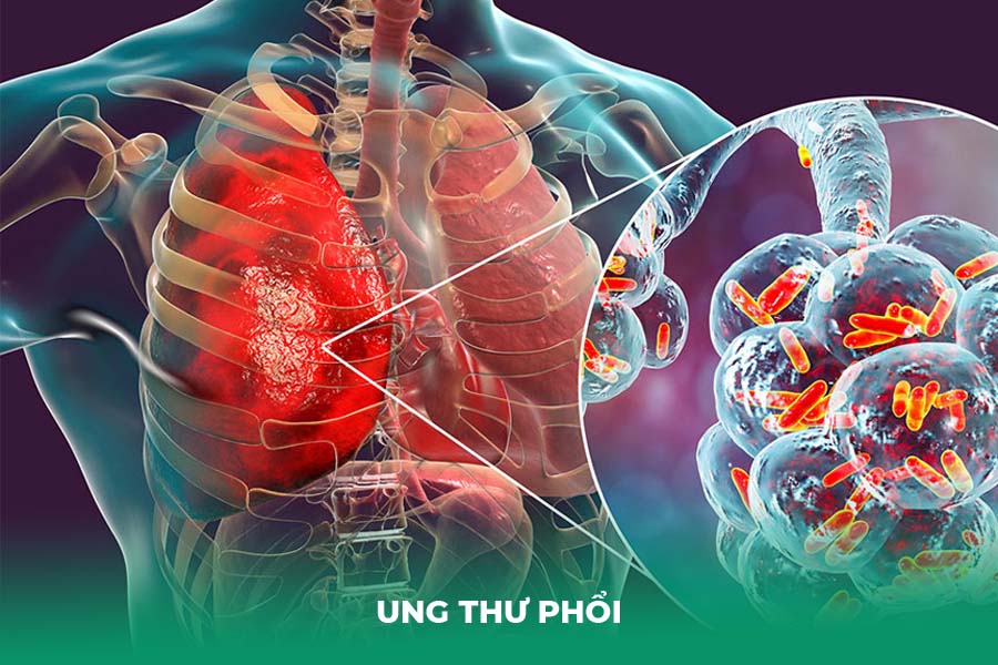 Ung Thư Phổi