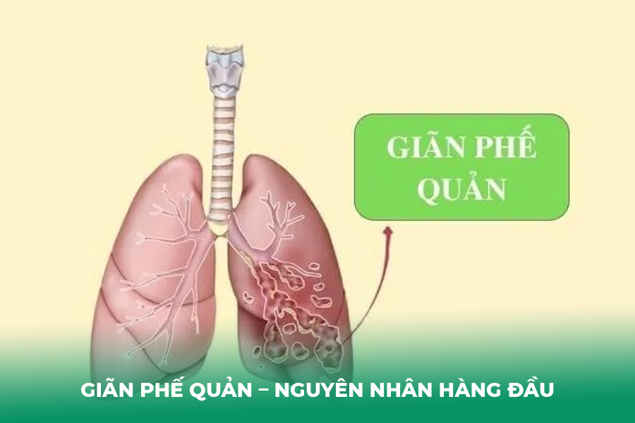 Giãn Phế Quản – Nguyên Nhân Hàng Đầu