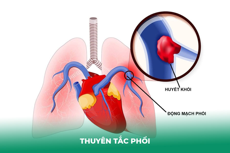 Thuyên Tắc Phổi