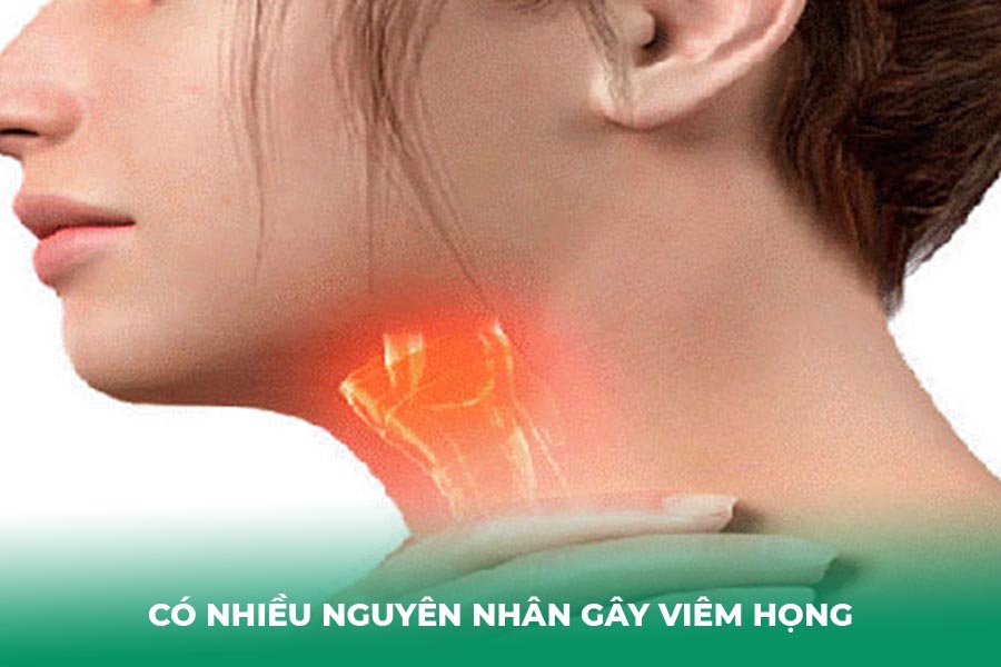 Có nhiều nguyên nhân gây viêm họng