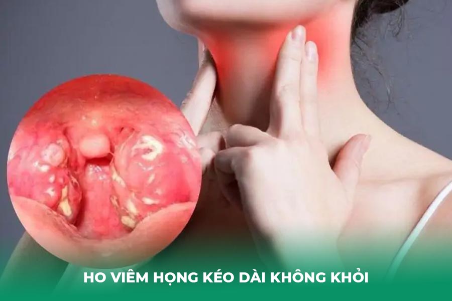 Viêm họng mạn tính