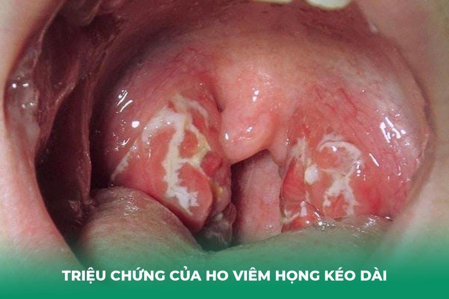 Triệu Chứng Của Ho Viêm Họng Kéo Dài