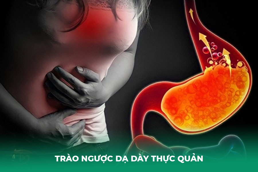 Trào Ngược Dạ Dày Thực Quản