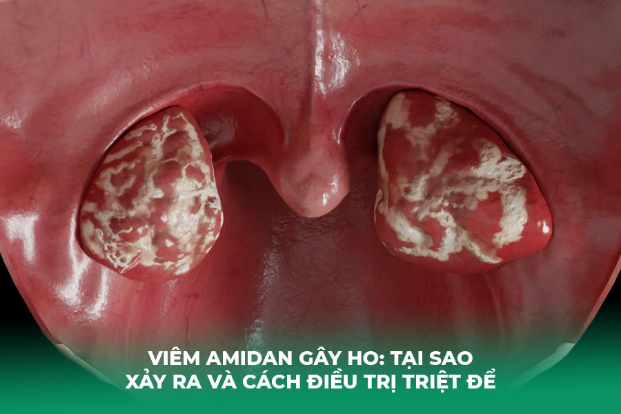 Viêm Amidan Gây Ho: Tại Sao Xảy Ra và Cách Điều Trị Triệt Để