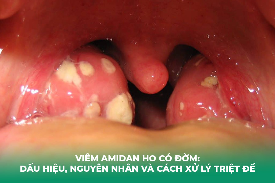 Viêm Amidan Ho Có Đờm: Dấu Hiệu, Nguyên Nhân và Cách Xử Lý Triệt Để