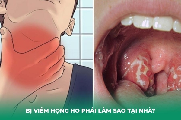 Bị Viêm Họng Ho Phải Làm Sao Hướng Dẫn Toàn Diện Từ Chuyên Gia