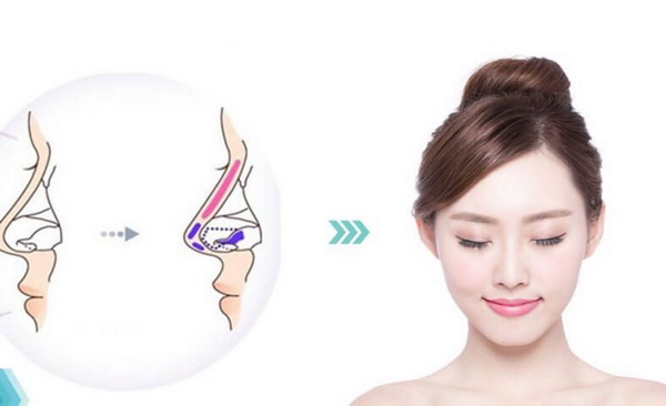 Bị viêm xoang có nên nâng mũi không