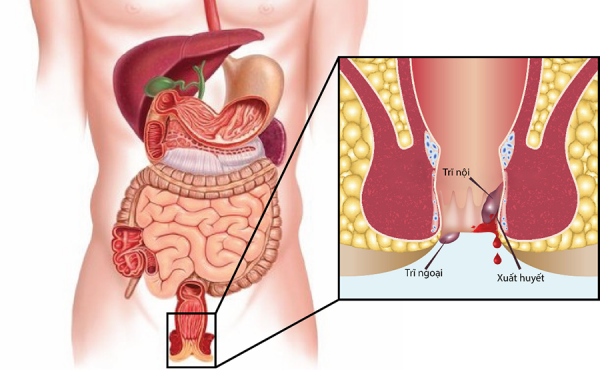 Mẹo chữa trĩ nhẹ tại nhà đơn giản và hiệu quả