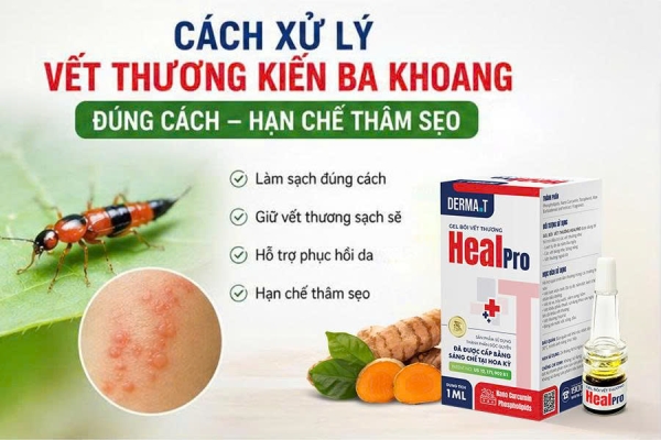 Cách Xử Lý Vết Thương Kiến Ba Khoang Cắn Đúng Cách