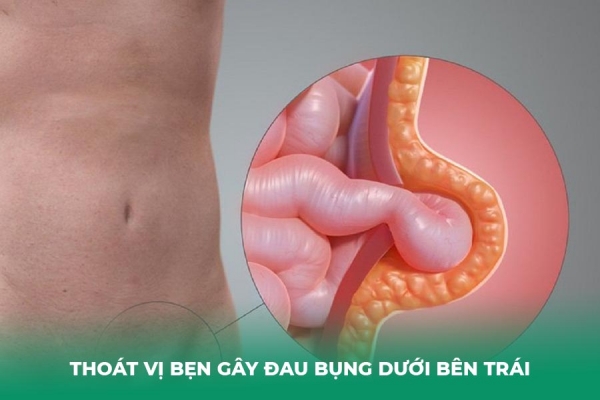 Ho Bị Đau Bụng Dưới Bên Trái Là Bệnh Gì Cách Giảm Đau Hiệu Quả