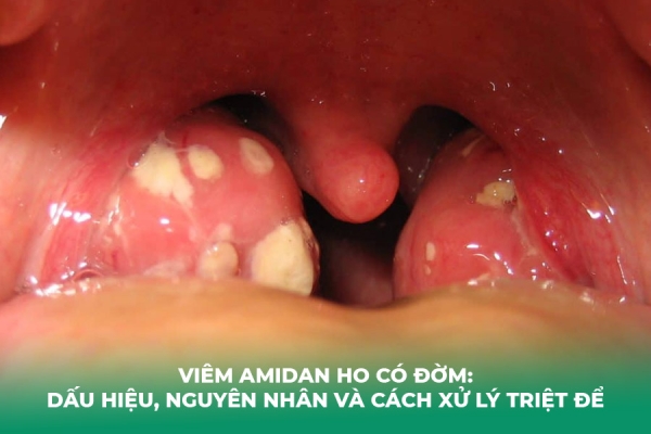 Viêm Amidan Ho Có Đờm: Dấu Hiệu, Nguyên Nhân và Cách Xử Lý Triệt Để